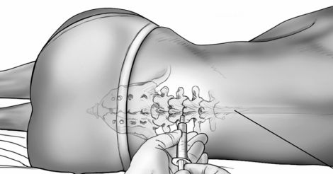 საკეისრო კვეთა საკეისრო კვეთა