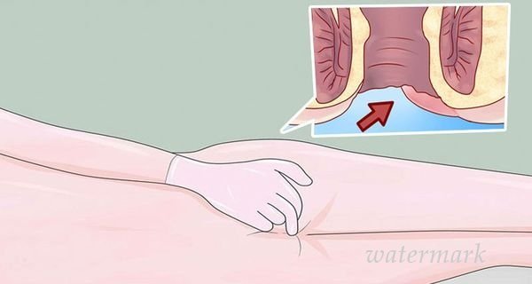 ანალური სიმსივნის სიმპტომები