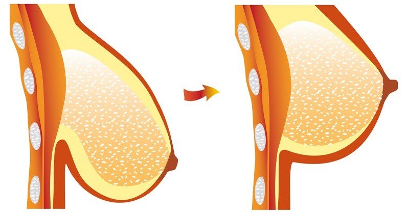 აირიდეთ თავიდან მოშვებული მკერდის პრობლემა – სასარგებლო რჩევები!