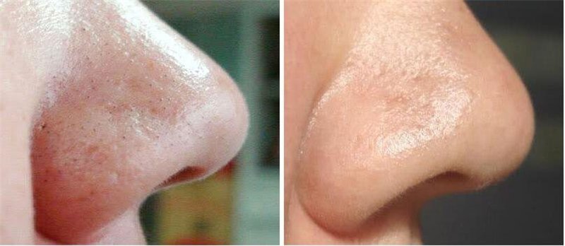 როგორ მოვიშოროთ ფერიჭამელები სახეზე: სპეციალისტის რჩევები