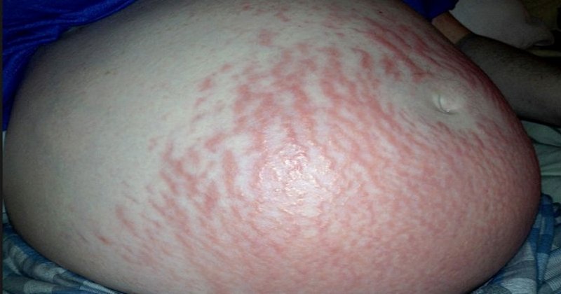 ფეხმძიმობისას მის მუცელზე წითელი ხაზები გაჩნდა. ის, რაც ყველა ქალს შეიძლება დაემართოს