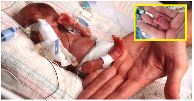 საოცარი ისტორია, თუ როგორ გადაარჩინეს ახალშობილი, რომელიც მხოლოდ 226გ იწონიდა!