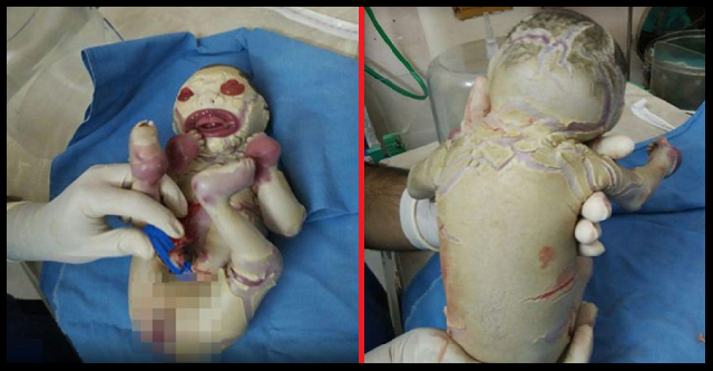 ინდოეთში დაბადებული ბავშვი, რომელმაც ექიმები შეაშინა სამ დღეში გარდაიცვალა!