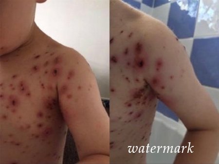 რამ შეიძლება გამოიწვიოს სავალალო შემთხვევა ჩუტყვავილის დროს. ეს ყველა მშობელმა უნდა იცოდეს ! რამ შეიძლება გამოიწვიოს სავალალო შემთხვევა ჩუტყვავილის დროს. ეს ყველა მშობელმა უნდა იცოდეს !