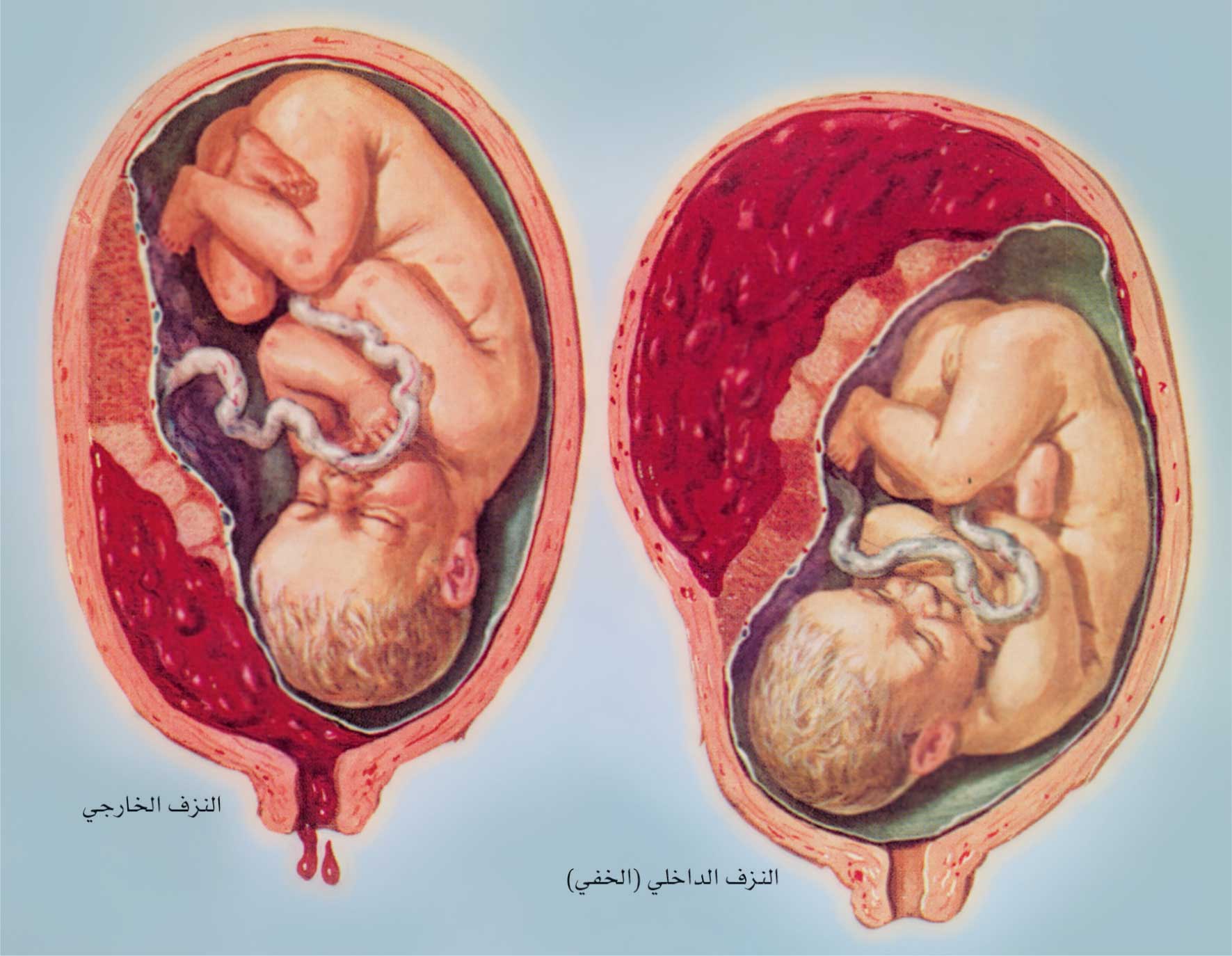 საკეისრო კვეთის შემდგომი ორსულობა და მშობიარობა