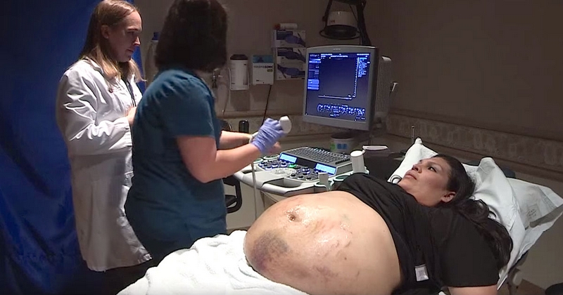 ამ ორსულ ქალს მუცელზე ლურჯი და იასამნისფერი ხაზები ჰქონდა! მიზეზი იშვიათი შემთხვევაა!