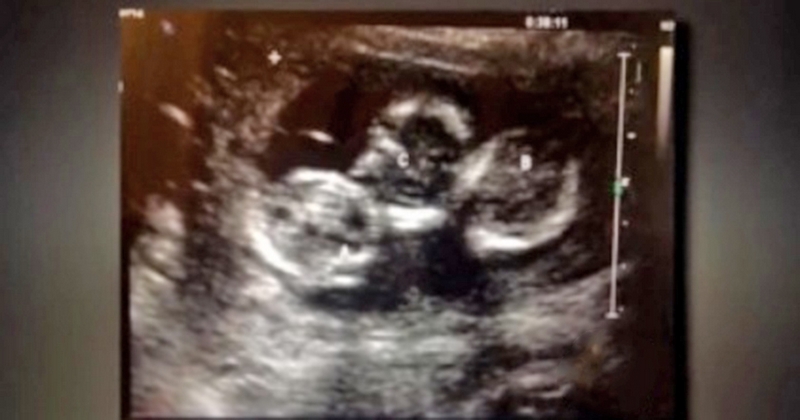 ქალი ტყუპებს ელოდა, მაგრამ რაც ექოსკოპიის კაბინეტში ეკრანზე გამოჩნდა უიშვიათესი რამაა