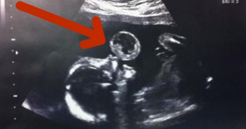 ექოსკოპიაზე ჩანს, რომ ბავშვი ბუშტს ბერავს, მაგრამ სინამდვილეში!  დაუჯერებელია